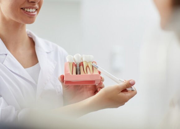 Four Reasons to Consider Dental Implants