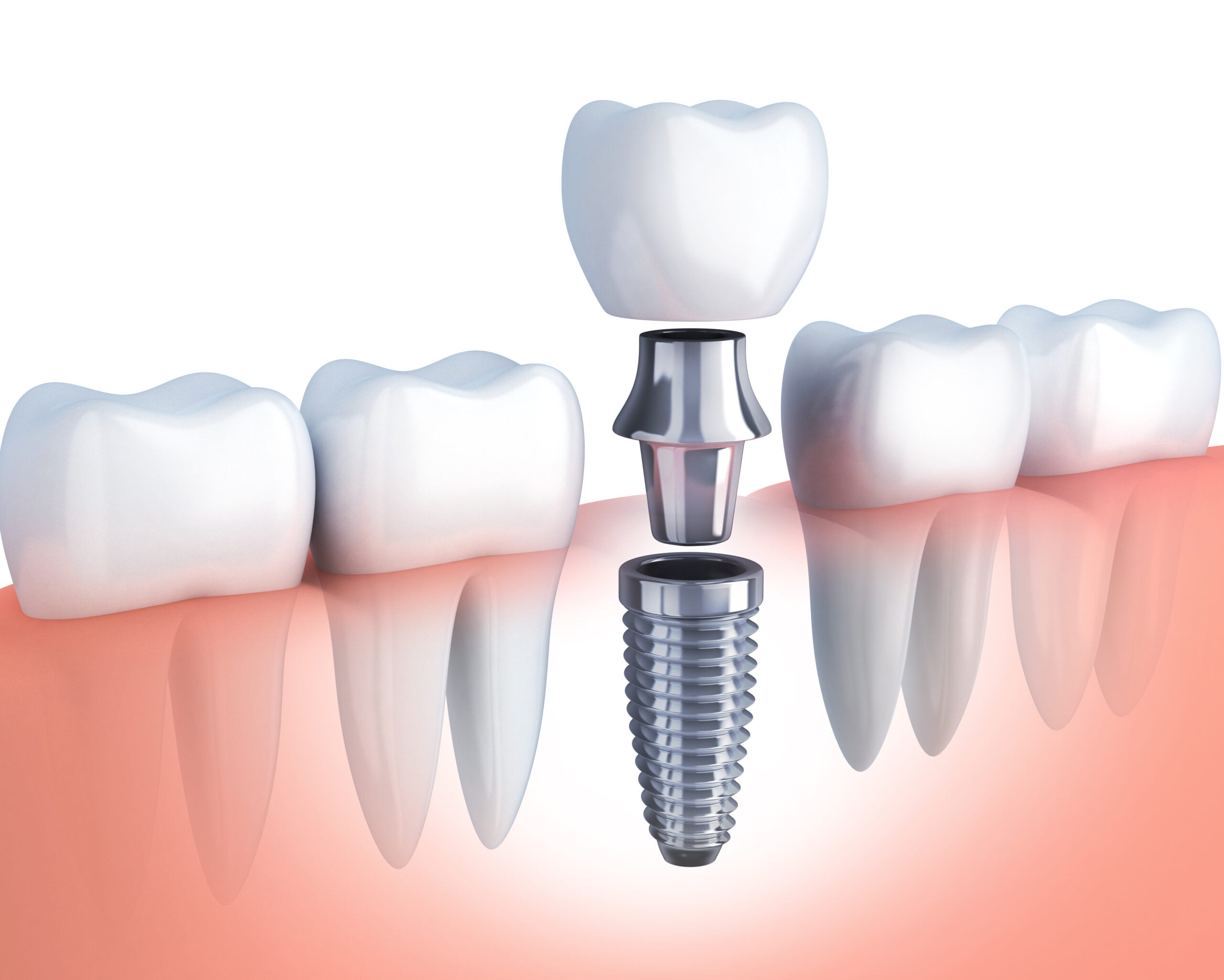 Is Caring for Dental Implants Different from Natural Teeth?