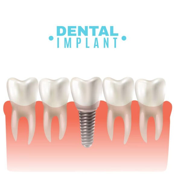 The Underrated Advantages of Dental Implants