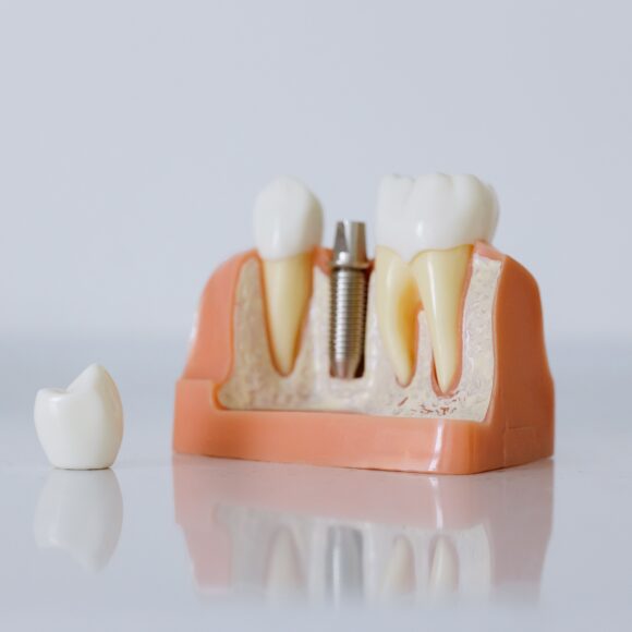 Why do some patients require a bone graft before receiving permanent tooth restorations?