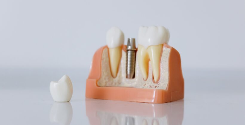Why do some patients require a bone graft before receiving permanent tooth restorations? Why do some patients require a bone graft before receiving permanent tooth restorations?